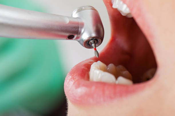 Best Chipped Tooth Repair Near Me  in Keasbey, NJ